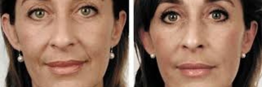 Before and After